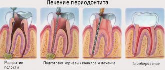 treatment of inflammation of tooth and gum tissues