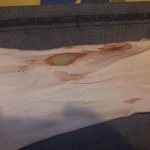 Bloody discharge can be treated with special medications.