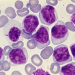 Leukemia under a microscope