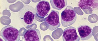 Лейкоз под микроскопом