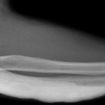 Мелореостоз