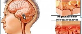 meningitis