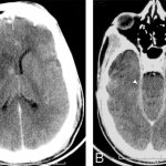 Meningoencephalitis in the picture