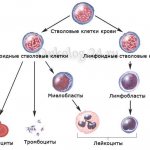 Миелобластный лейкоз