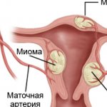 Uterine fibroids - symptoms and treatment of the disease at different stages
