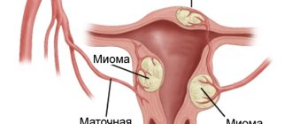 Миома матки – симптомы и лечение болезни на разных стадиях