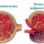 нефросклероз почек, что это такое и какой исход заболевания