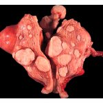 Некроз миоматозного узла