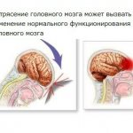 Emergency care for a concussion