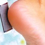 Improper foot care as a cause of cracked heels