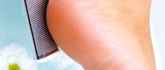 Improper foot care as a cause of cracked heels