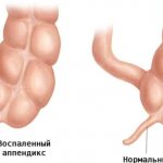 нормальный и воспаленный аппендикс