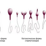 Oligoasthenoteratozoospermia: the concept of the disease