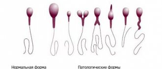 Олигоастенотератозооспермия: понятие заболевания