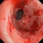 омепразол от гастрита