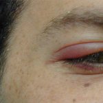 Онкология века глаза как начинается