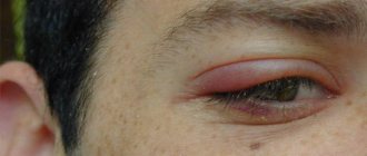 Oncology of the eyelid how it begins