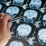 Опухоль мозга