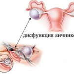 Main signs and symptoms of ovarian dysfunction