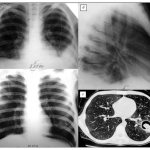 Features of the treatment of aspergillosis