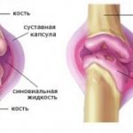 Features of the treatment of acute arthrosis of the knee joint