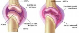 Features of the treatment of acute arthrosis of the knee joint