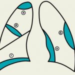 Encapsulated pleurisy