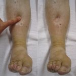 Swelling of the legs