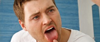 tongue burn