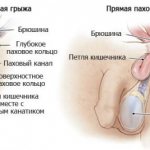 Inguinal hernia in men - symptoms and treatment, photos and videos.
