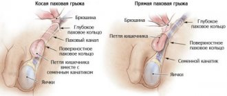 Паховая грыжа у мужчин – симптомы и лечение, фото и видео.