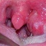 Peritonsillar abscess