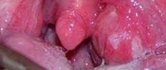 Peritonsillar abscess