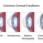 Corneal pathology manifests itself in various diseases