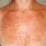 печеночная порфирия что это