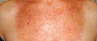 hepatic porphyria what is it