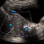 Torsion of the pedicle of an ovarian cyst