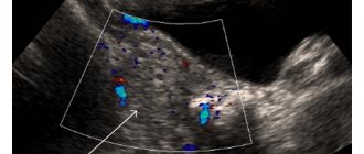 Torsion of the pedicle of an ovarian cyst