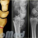 перелом лучевой кости руки