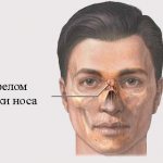 Nasal fracture: symptoms and treatment