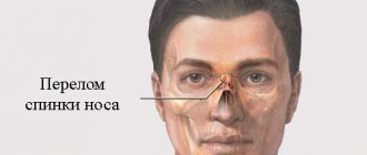 Nasal fracture: symptoms and treatment