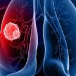 Периферический рак легкого