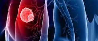 Peripheral lung cancer