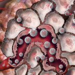 Pilocytic astrocytoma, what is it?