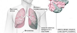 Пневмосклероз легких