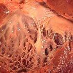 Why does cardiomyopathy occur: what is it and its treatment