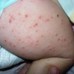 Почесуха детская