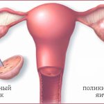 Polycystic ovary syndrome