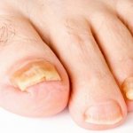 Fungal infection of toenails