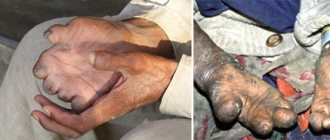 последствия лепра фото